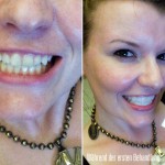 Erstbehandlung mit Crest §D WHITE Whitestrips Bleaching / Whitening Dental Treatment Foto