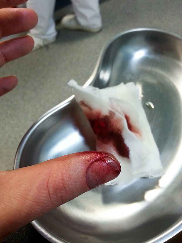 Wunde etwas über zwei Stunden nach dem Schnitt: Fingerkuppe hängt noch an einem Fitzel Haut.
