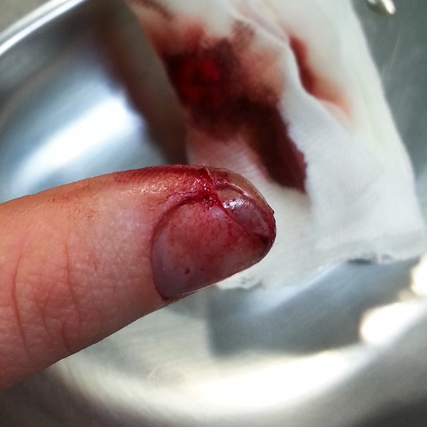 Wunde etwas über zwei Stunden nach dem Schnitt: Fingerkuppe hängt noch an einem Fitzel Haut.